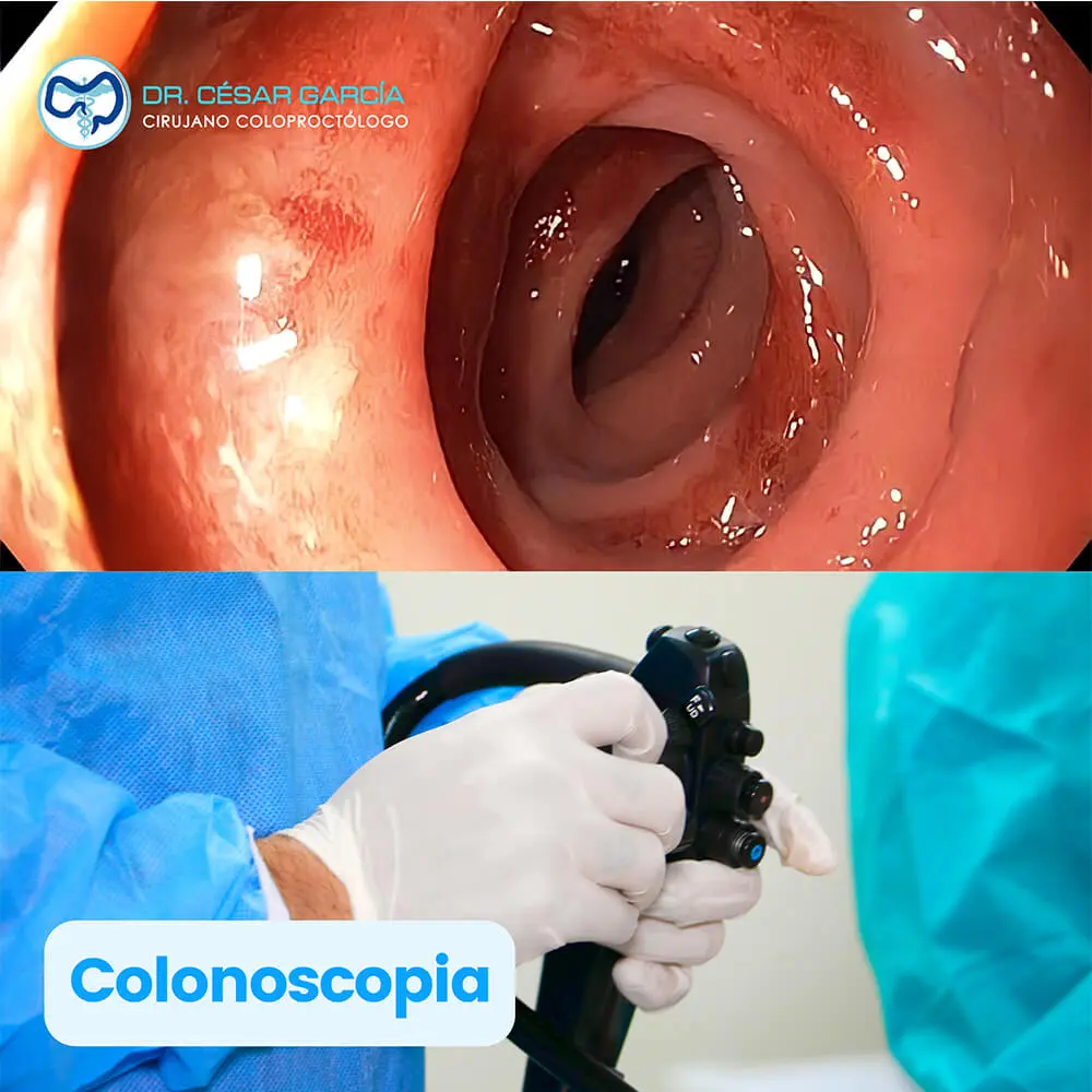 Colonoscopia para detección temprana de cáncer de colon en Tampico