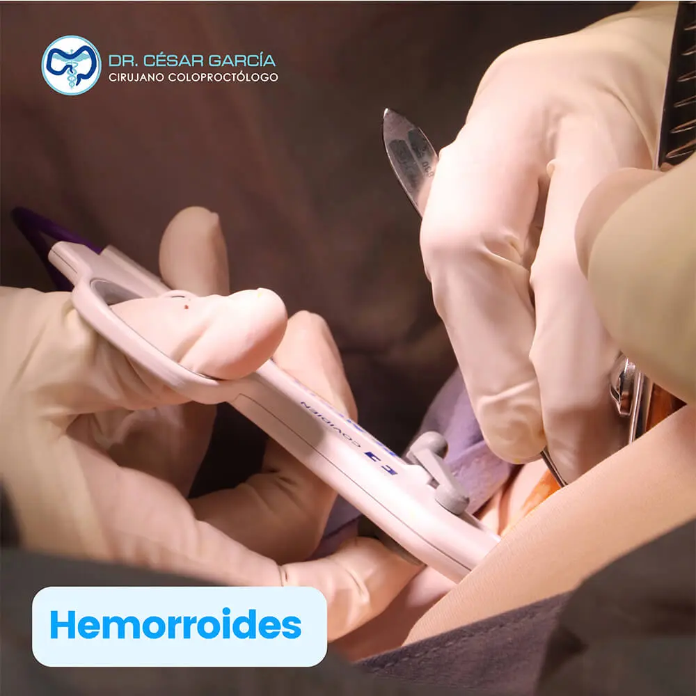Tratamiento de hemorroides con láser THD PPH en Tampico