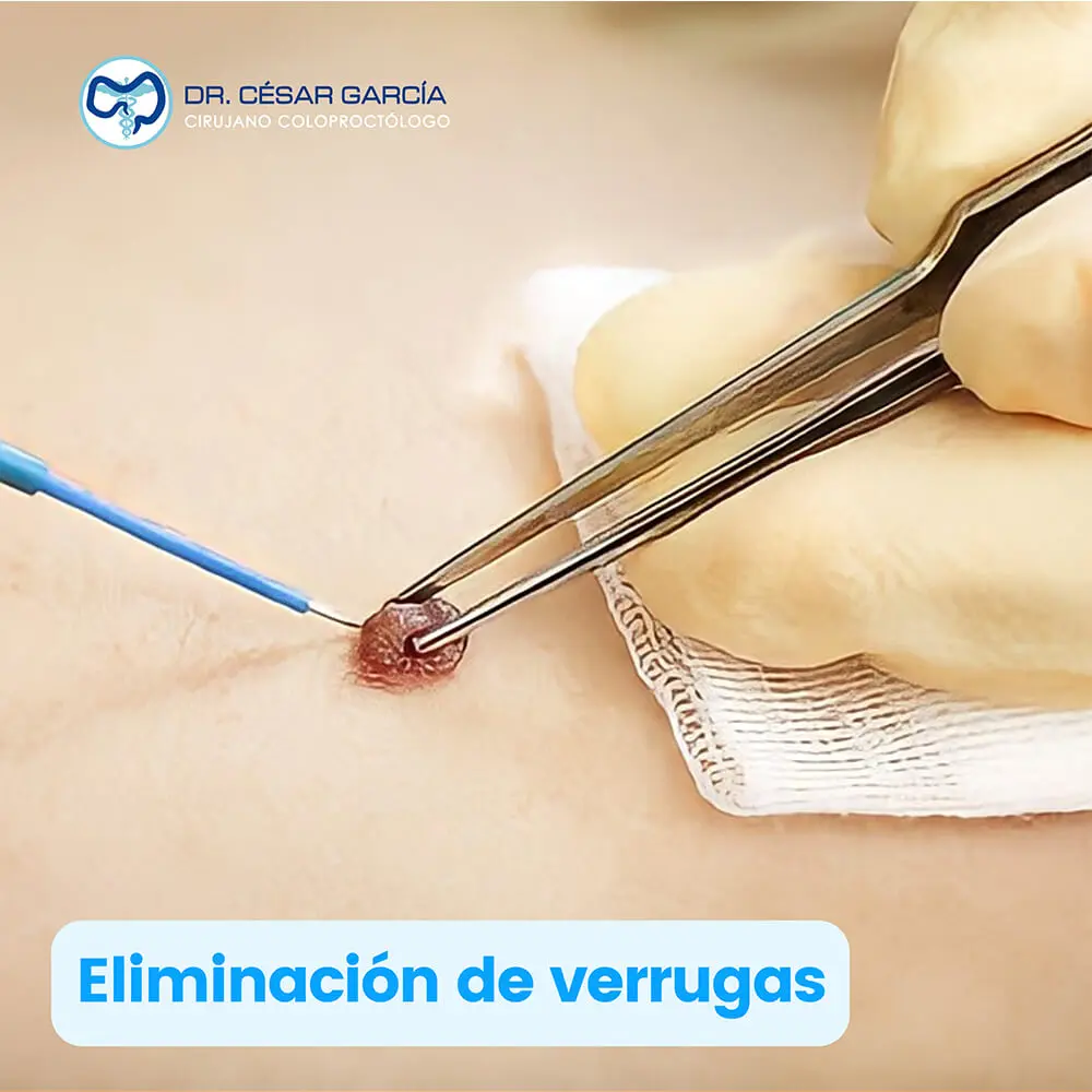 Eliminación de verrugas anales causadas por VPH en Tampico